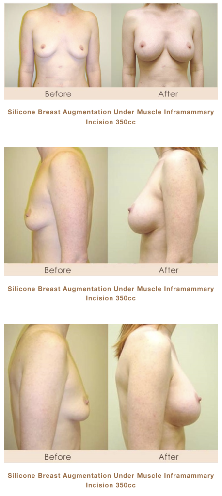 silicone breast augmentation in Michigan by Dr. Michael W. Gray